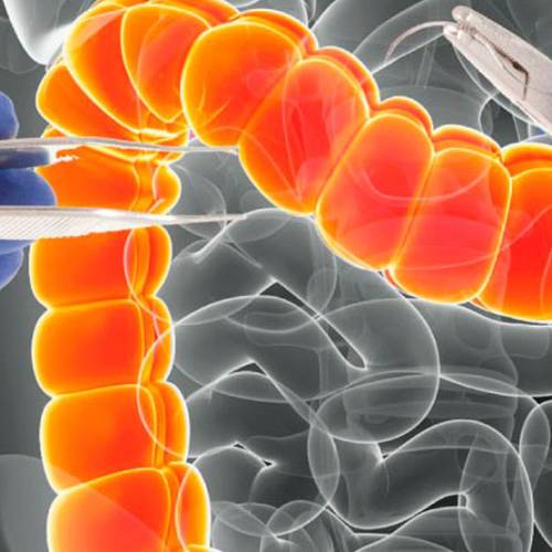 Simposio Actualización en Neoplasias Colorrectales Infrecuentes