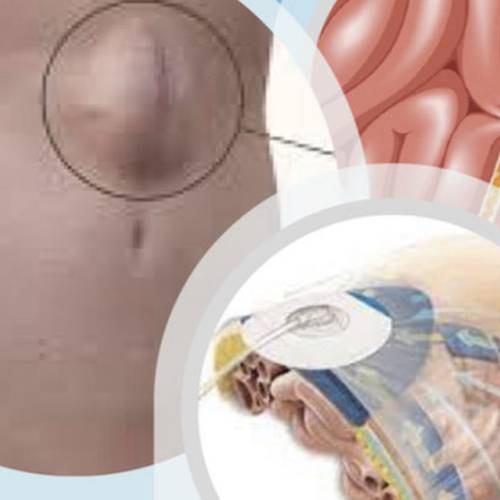 Jornada de Actualización: Hernias Incisionales y Abdomen complejo